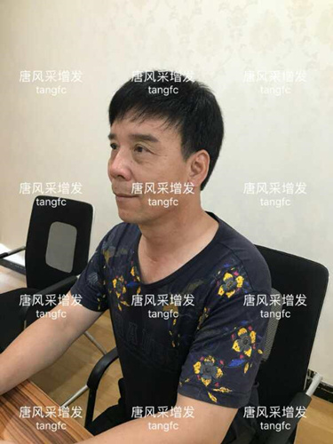 朋友碰面不敢認(rèn)，直擊發(fā)友增發(fā)后的真實(shí)改變！