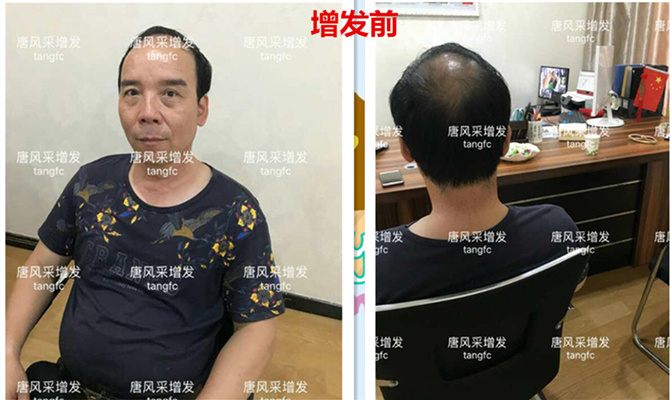 朋友碰面不敢認(rèn)，直擊發(fā)友增發(fā)后的真實(shí)改變！