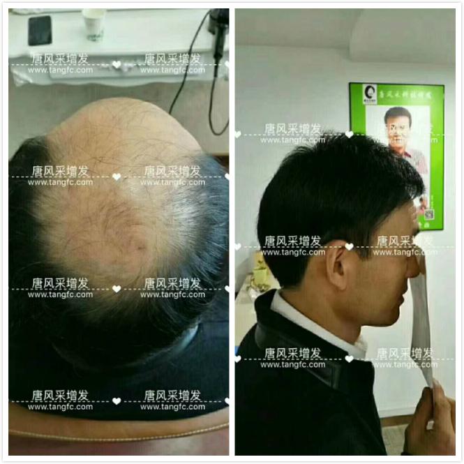 臺州哪里買假發(fā)好，頭發(fā)稀疏適合什么樣的假發(fā)？