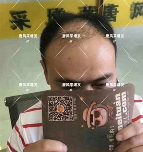 西寧織發(fā)補(bǔ)發(fā)哪家好，真的能改變我的脫發(fā)形象嗎？ 