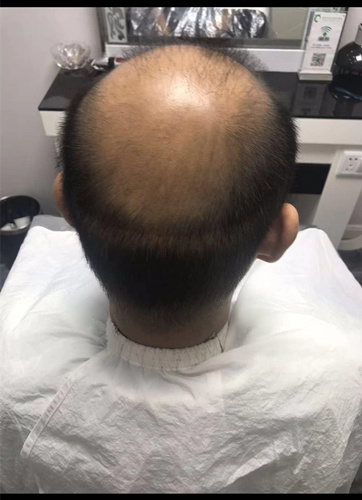 西寧織發(fā)補(bǔ)發(fā)哪家好，真的能改變我的脫發(fā)形象嗎？ 