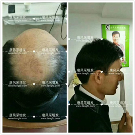 頭發(fā)稀少，頭發(fā)怎么才能變濃密？