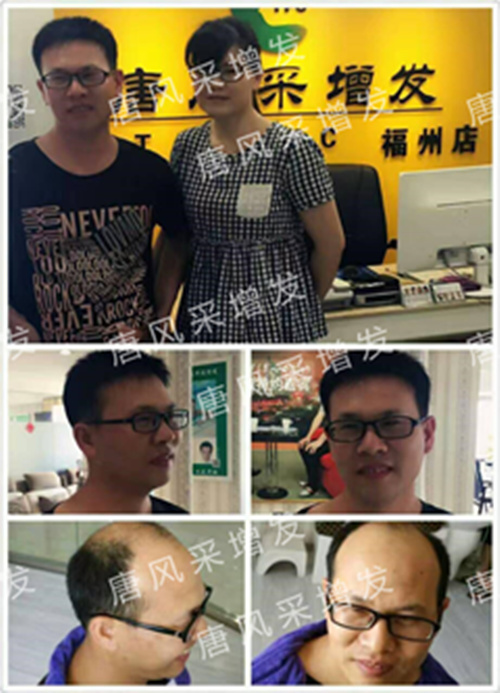 老師，我要你“脫”掉禿頂！