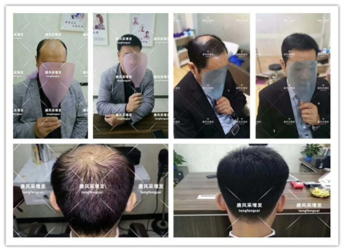 無(wú)痕增發(fā)