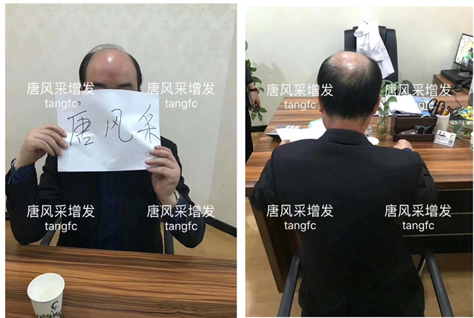 唐風采假發(fā)案例 ，脫發(fā)謝頂后