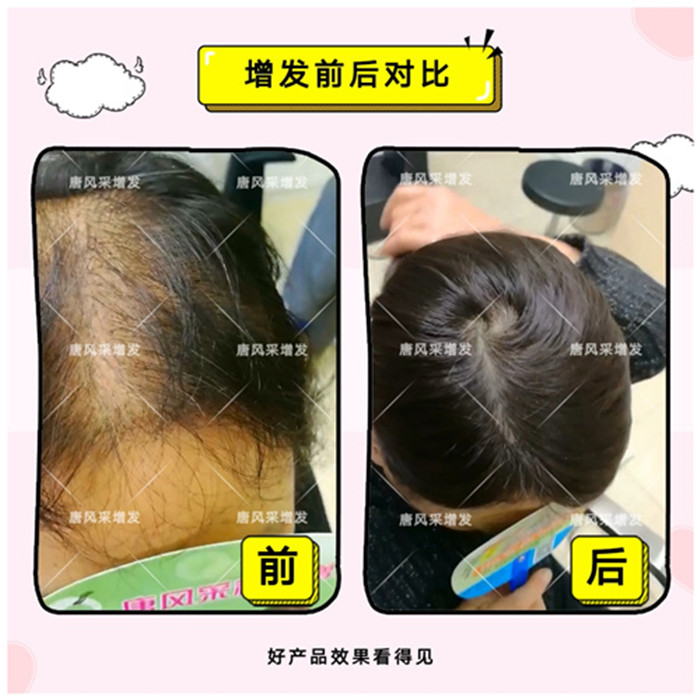 頭發(fā)稀疏！