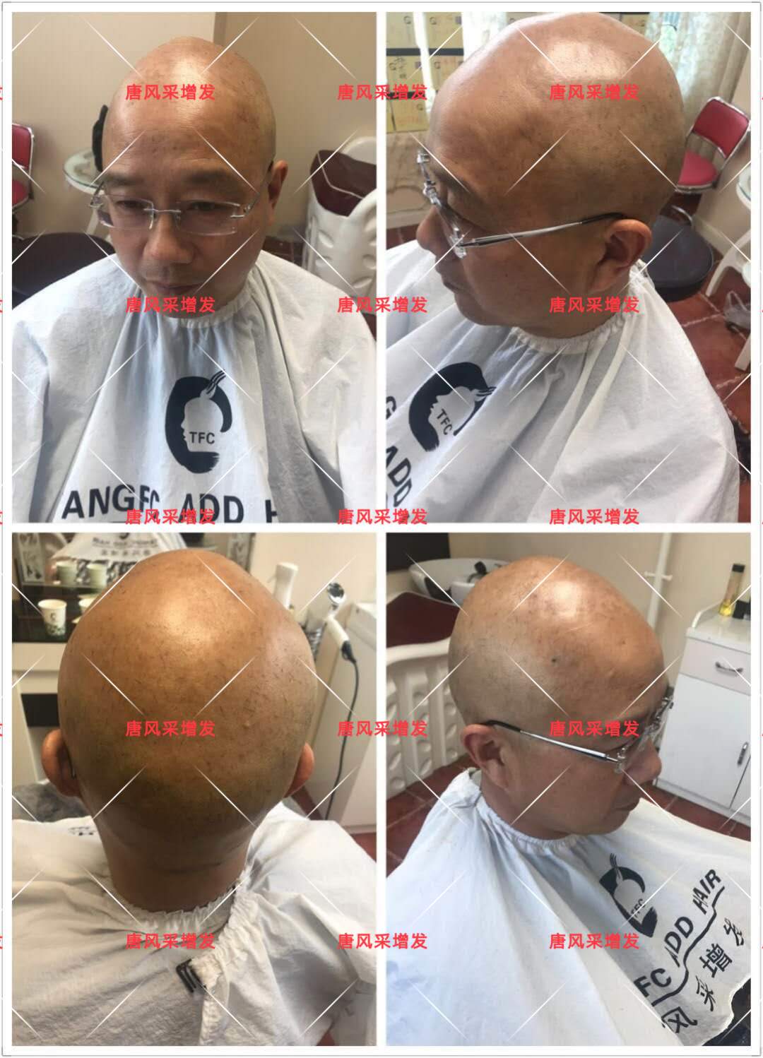 10年脫發(fā)困擾，一次性解決，唐風(fēng)采助力查先生“夢(mèng)想成真”