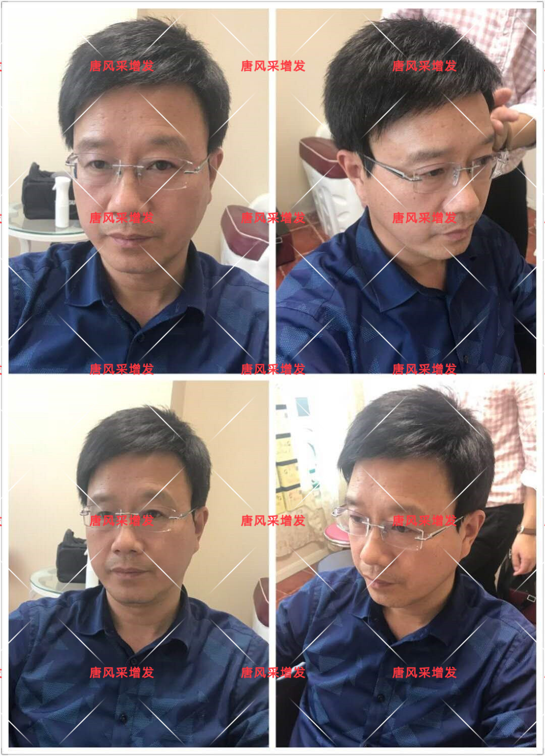 10年脫發(fā)困擾，一次性解決，唐風(fēng)采助力查先生“夢(mèng)想成真”