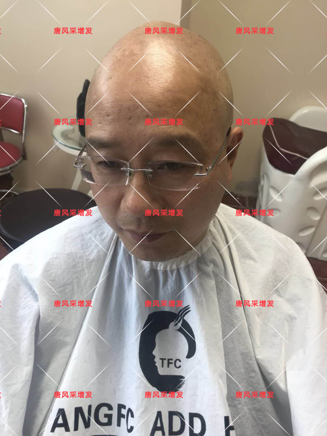 10年脫發(fā)困擾，一次性解決，唐風(fēng)采助力查先生“夢(mèng)想成真”