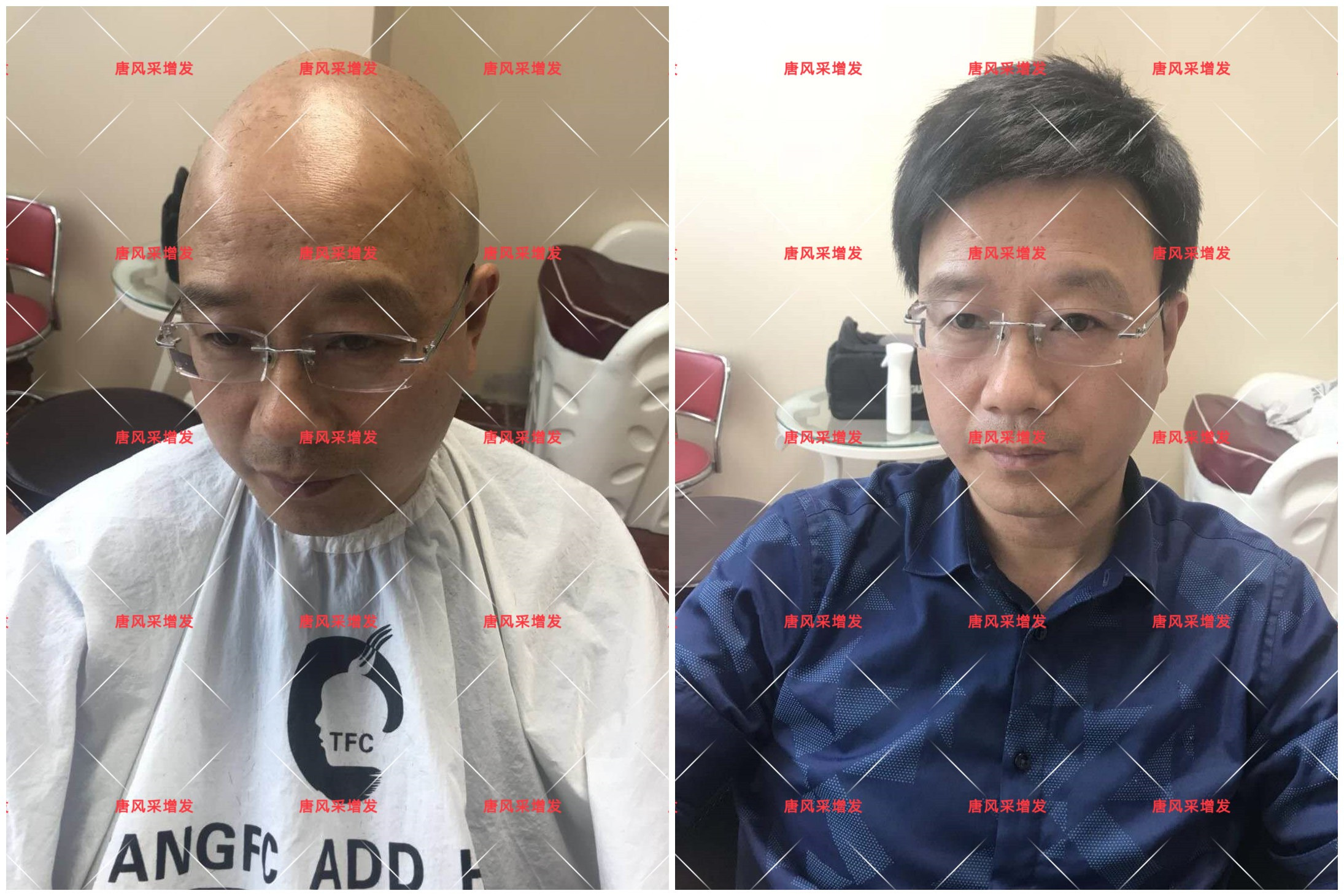 10年脫發(fā)困擾，一次性解決，唐風(fēng)采助力查先生“夢(mèng)想成真”