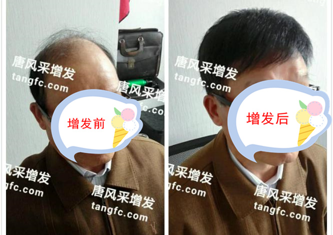 開始脫發(fā)的朋友上醫(yī)院，見到專家后他徹底絕望了！