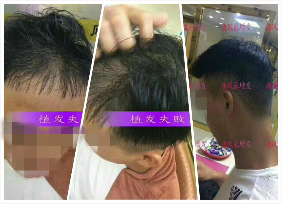 開始脫發(fā)的朋友上醫(yī)院，見到專家后他徹底絕望了！