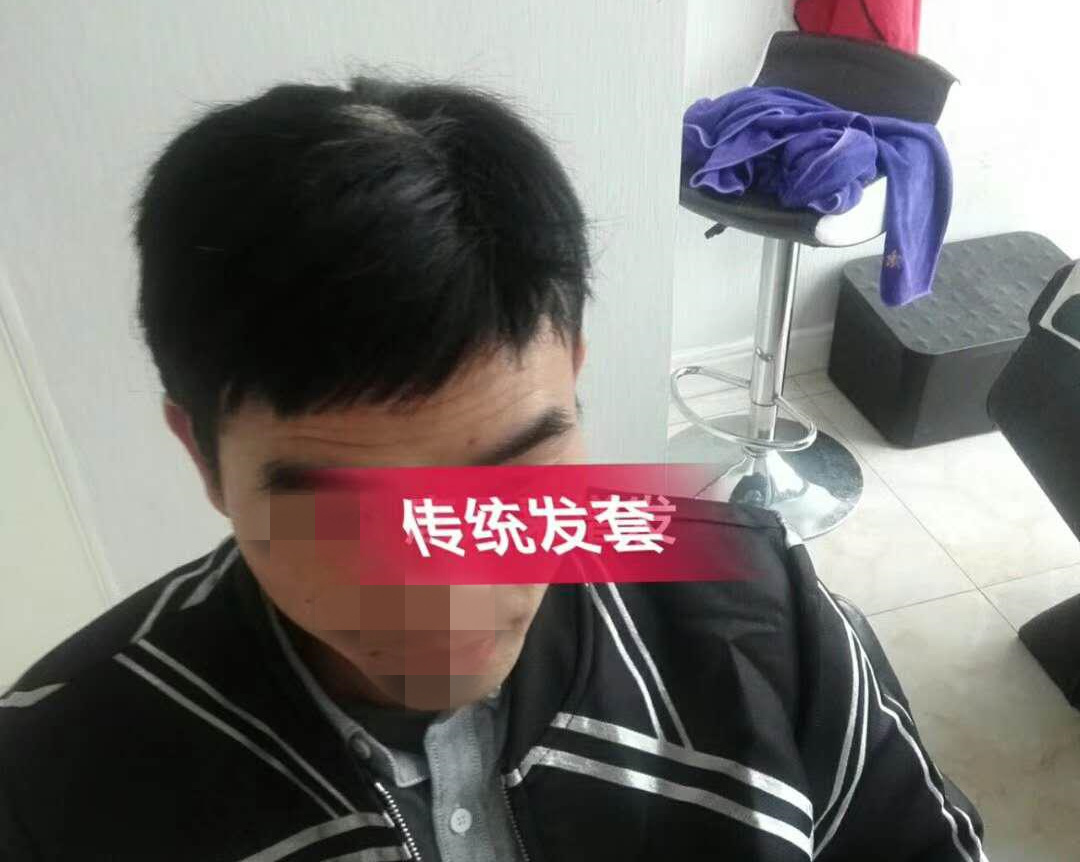開始脫發(fā)的朋友上醫(yī)院，見到專家后他徹底絕望了！