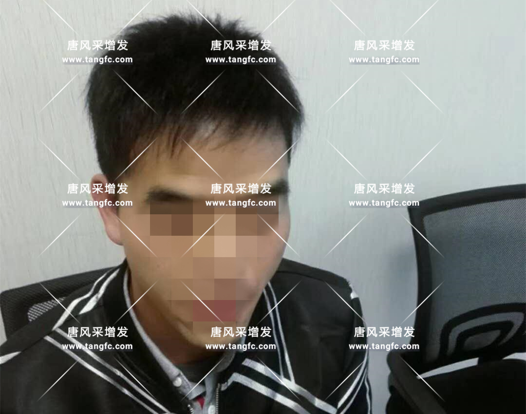 開始脫發(fā)的朋友上醫(yī)院，見到專家后他徹底絕望了！