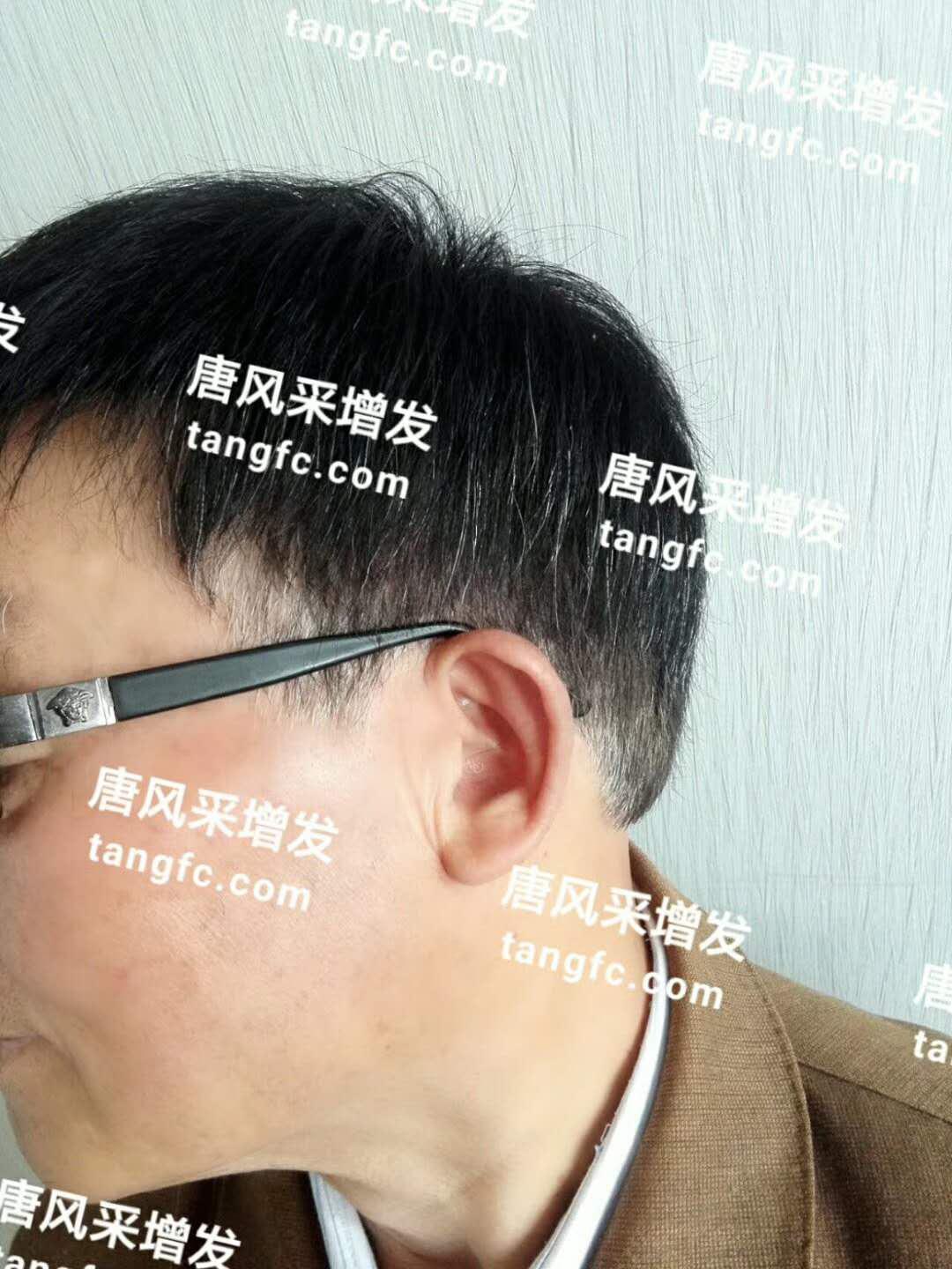 開始脫發(fā)的朋友上醫(yī)院，見到專家后他徹底絕望了！